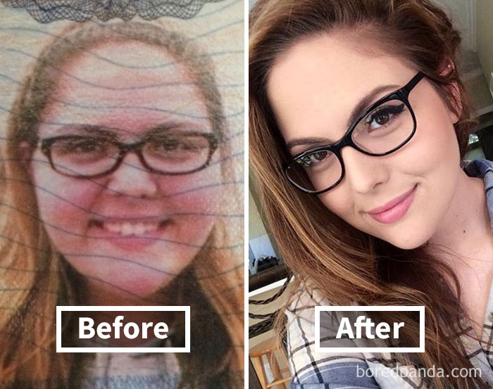 Face fat loss transformation shown in before and after photos.