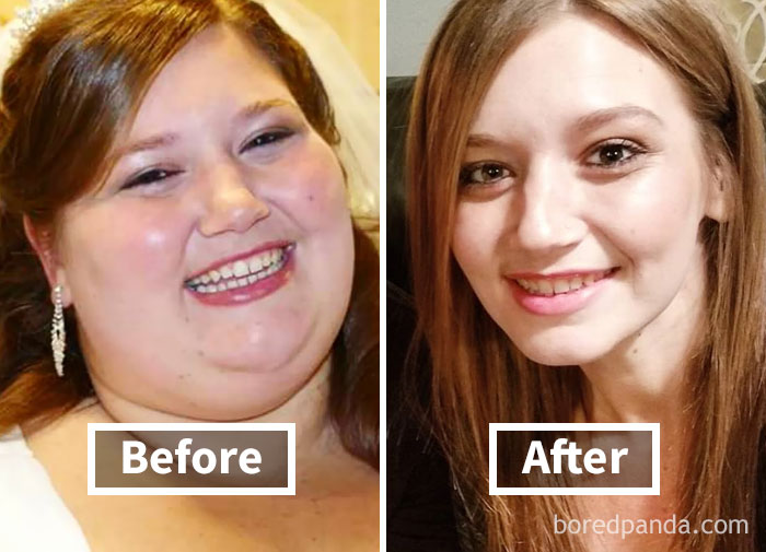Before and after face fat loss in weight loss transformation photo.