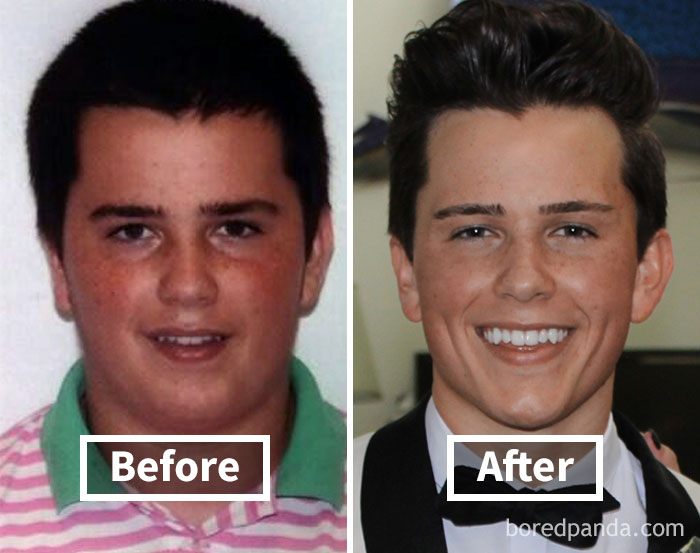 Face fat loss before and after weight loss, showing significant transformation in the person's appearance.