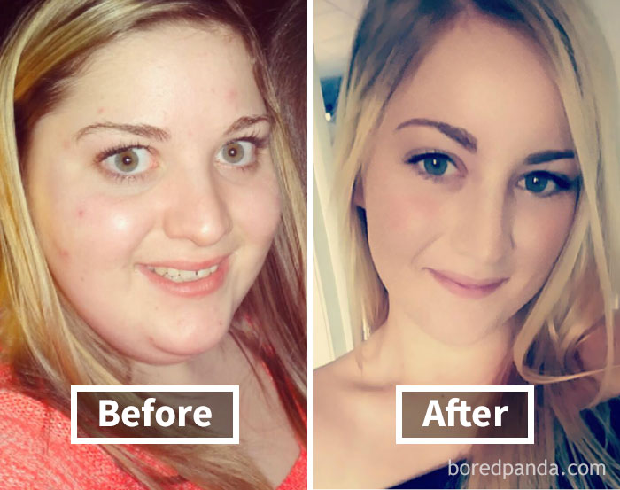 Before and after weight loss showing face fat reduction in a woman.