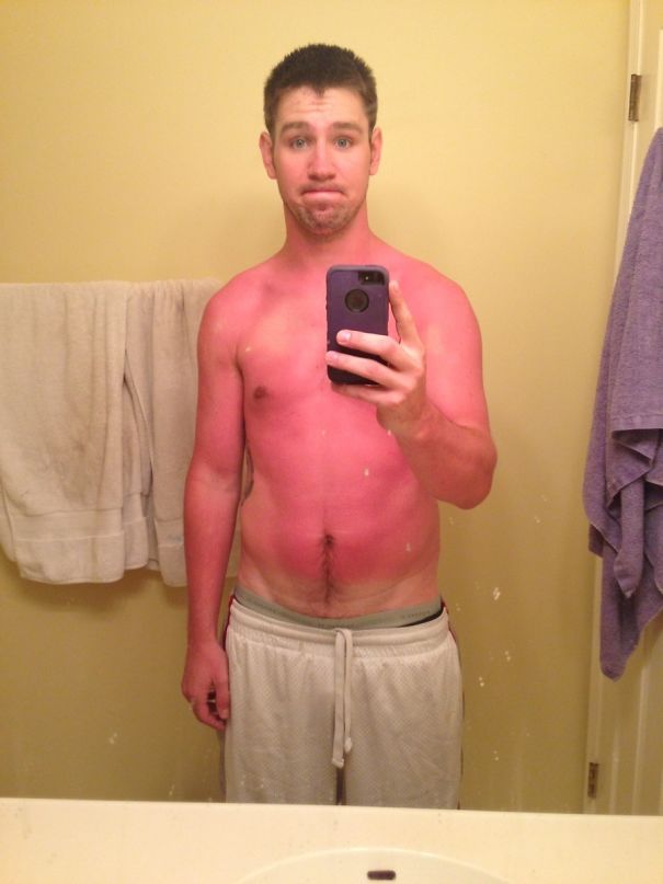 Yesterday I Made A Poor Decision About My Skin And The Effect Of Prolonged Sun Exposure