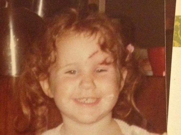 Attacked By Our Cat And My Parents Take Pictures. Love Cats And Have A Nice Scar.