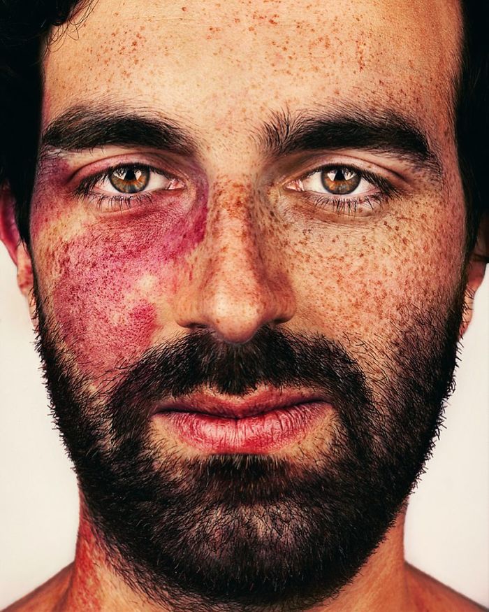 The Beauty Of The Freckles By The Photographer Brock Elbank