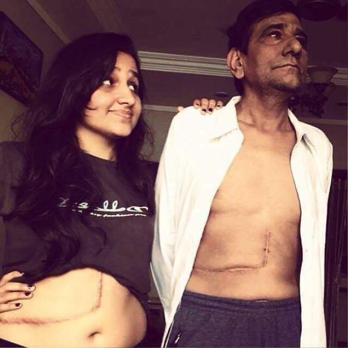 Daughter Underwent Liver Transplant To Save Her Father's Life