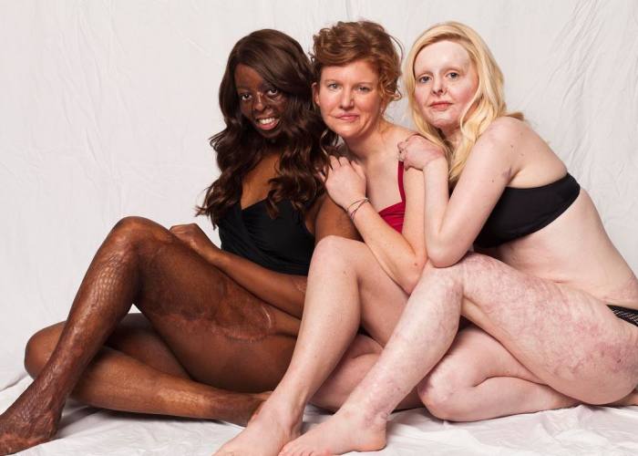 I Started This Campaign To Encourage People Love Themselves With All Their Differences