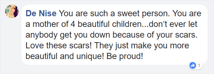 Trolls Tell 23-Year-Old Mom Her ‘Disgusting’ Stretch Marks Make Them Want To Vomit, But She Had The Best Response Trolls Tell 23-Year-Old Mom Her ‘Disgusting’ Stretch Marks Make Them Want To Vomit, But She Had The Best Response