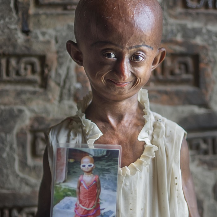 Doctors Gave This Girl 3 More Years To Live, And She’s Becoming An Example On How To Enjoy Life