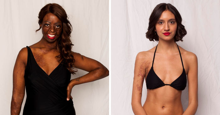 I Started This Campaign To Encourage People Love Themselves With All Their Differences