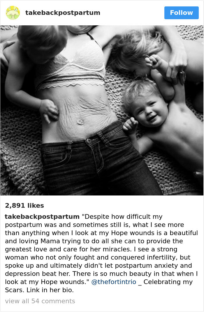 Postpartum Bodies