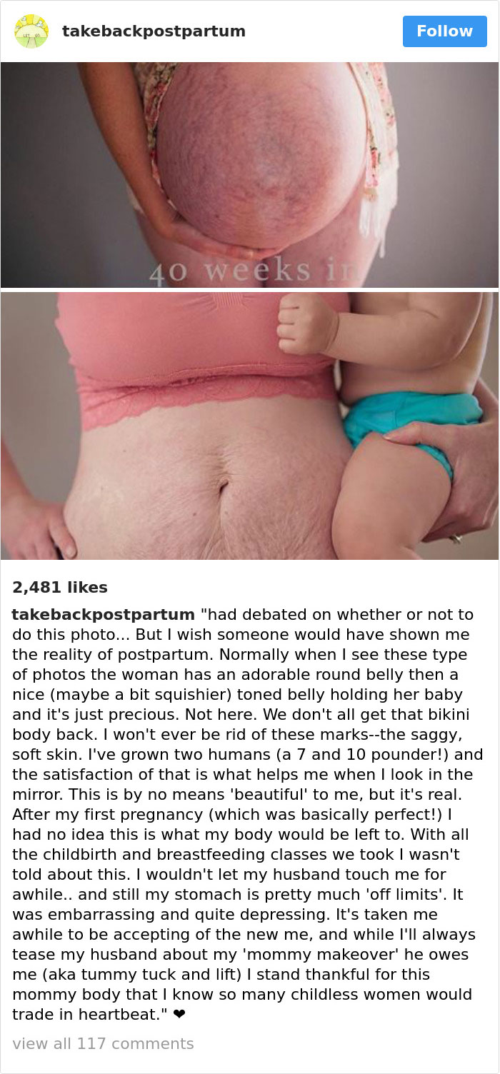 Postpartum Bodies