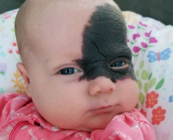 This Baby Was Born With A Birthmark Which Turned Her Into "Little Superhero"