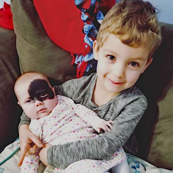 This Baby Was Born With A Birthmark Which Turned Her Into "Little Superhero" This Baby Was Born With A Birthmark Which Turned Her Into "Little Superhero"