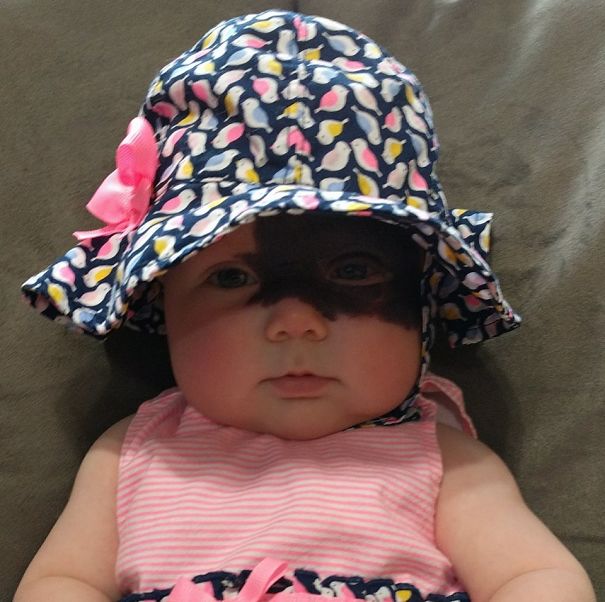 This Baby Was Born With A Birthmark Which Turned Her Into "Little Superhero"
