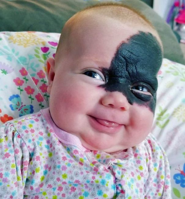 This Baby Was Born With A Birthmark Which Turned Her Into "Little Superhero" This Baby Was Born With A Birthmark Which Turned Her Into "Little Superhero"