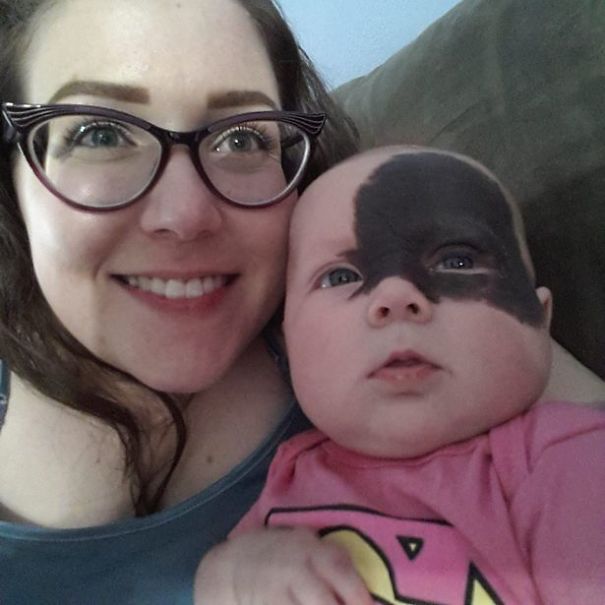 This Baby Was Born With A Birthmark Which Turned Her Into "Little Superhero"