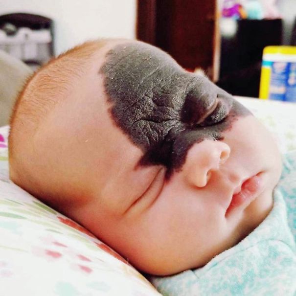 This Baby Was Born With A Birthmark Which Turned Her Into "Little Superhero" This Baby Was Born With A Birthmark Which Turned Her Into "Little Superhero"