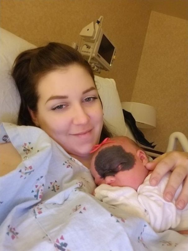 This Baby Was Born With A Birthmark Which Turned Her Into "Little Superhero" This Baby Was Born With A Birthmark Which Turned Her Into "Little Superhero"