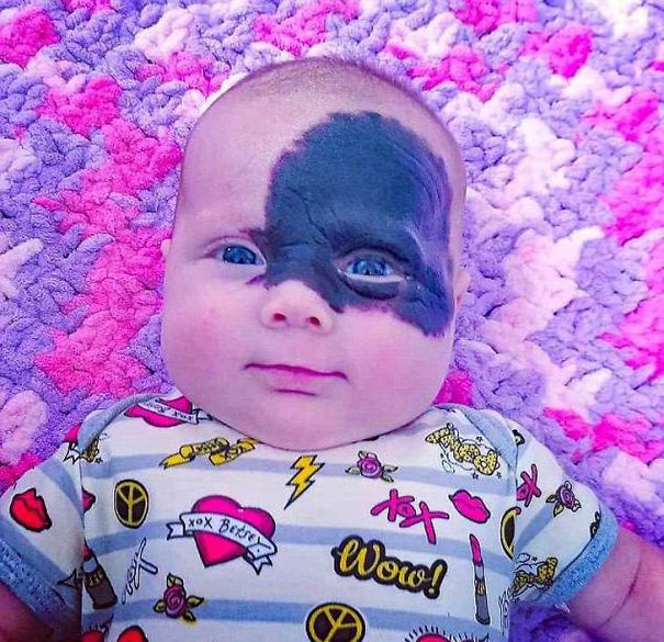 This Baby Was Born With A Birthmark Which Turned Her Into "Little Superhero"
