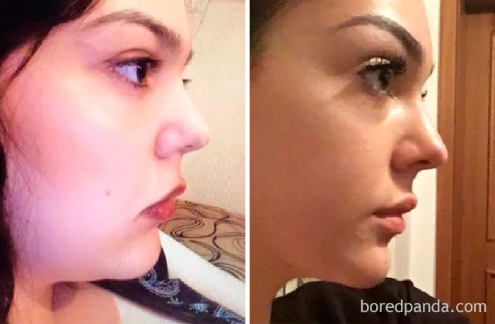 What Losing 70 Lbs Did To My Face