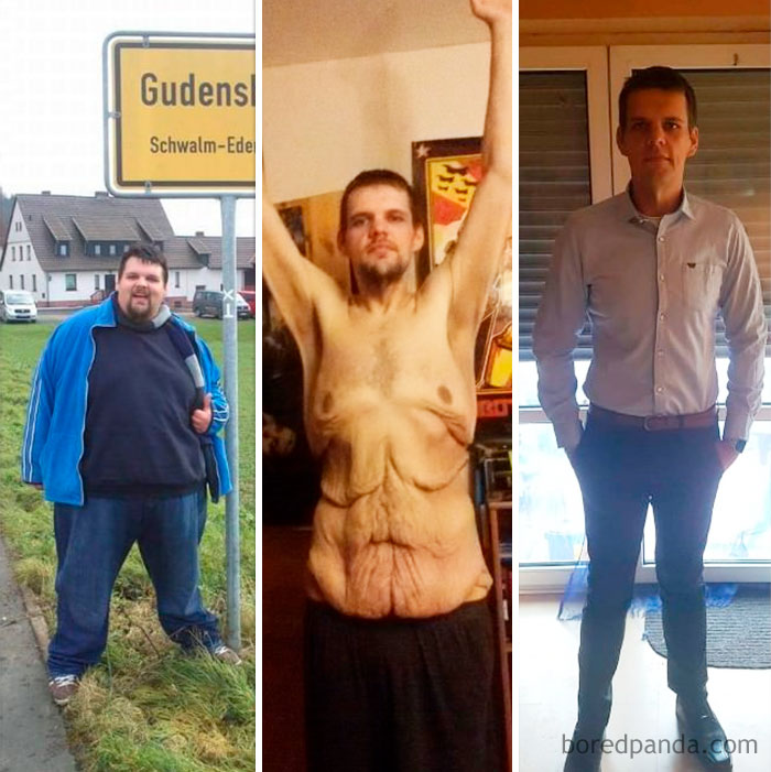 Me 2015 Vs Me 2017. I Have Lost 175 Kg In 2 Years