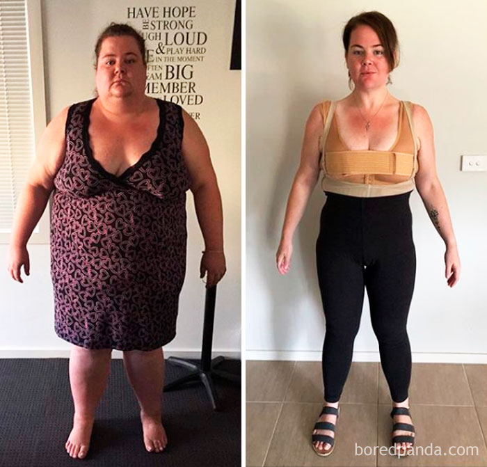 Lost 222 Lbs. Weight Loss Progress