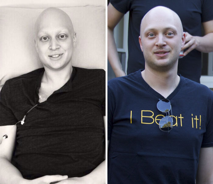 Победили рак сами. Люди до и после химиотерапии. Люди с онкологией до и после. Люди после химиотерапии до и после. Люди после химиотерапии фото.