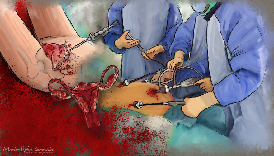 I Make Rough Drawings To Show The Reality Of Endometriosis I Make Rough Drawings To Show The Reality Of Endometriosis