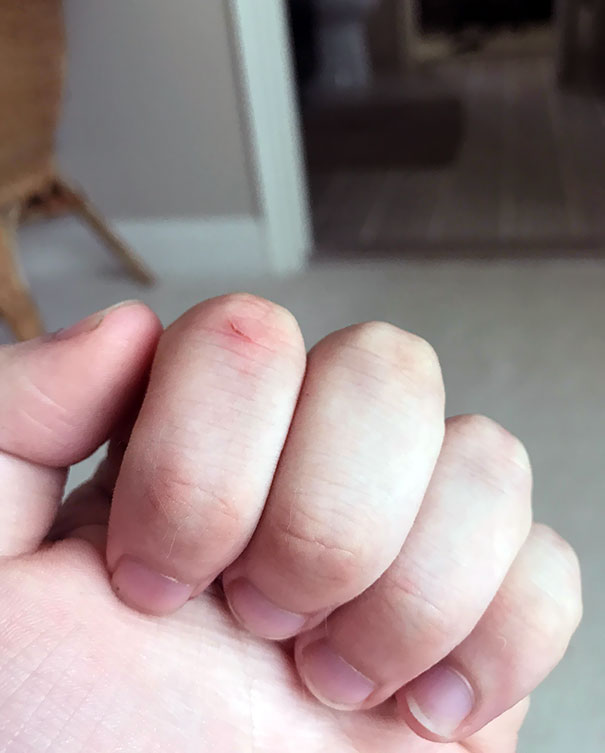 These Tiny Cuts That Randomly Show Up And Itch Like Hell