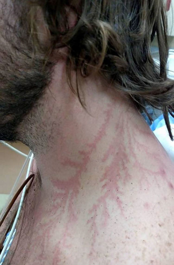 Close-up of a person's neck showing red Lichtenberg scars from a lightning strike on skin. Close-up of a person's neck showing red Lichtenberg scars from a lightning strike on skin.