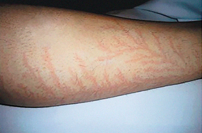 Lichtenberg scars appearing as red, branching patterns on a person's forearm against a white background. Lichtenberg scars appearing as red, branching patterns on a person's forearm against a white background.