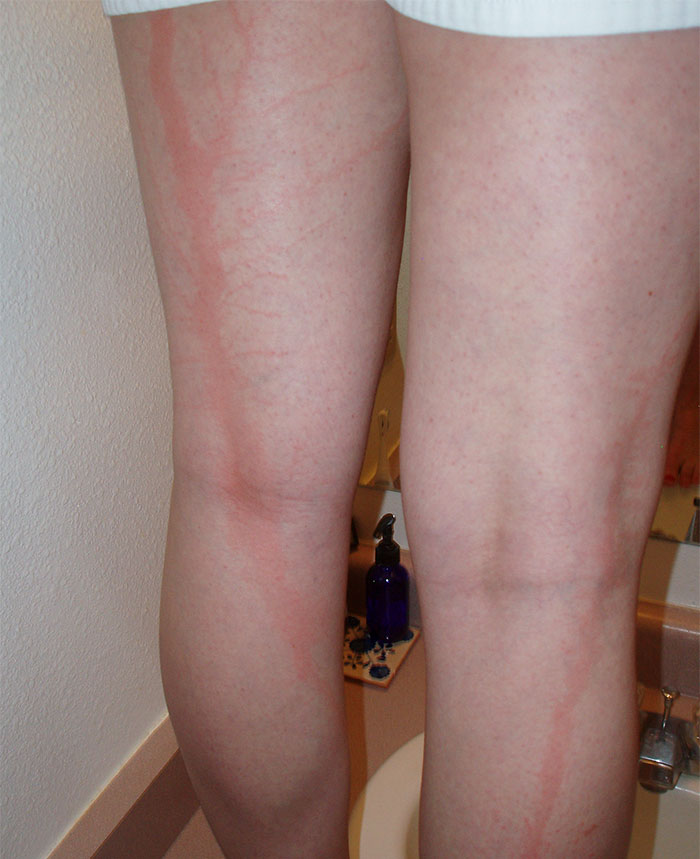 Visible Lichtenberg scars on the back of a person's legs showing the distinctive branching patterns on pale skin. Visible Lichtenberg scars on the back of a person's legs showing the distinctive branching patterns on pale skin.