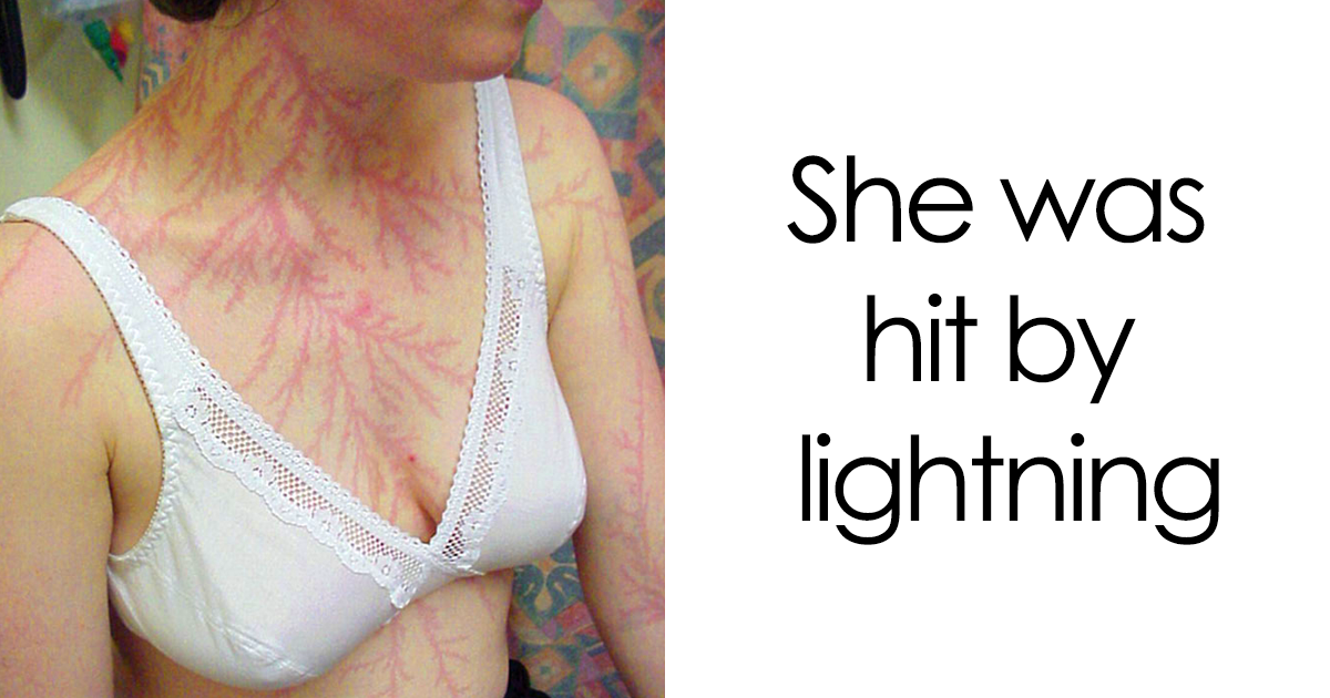 Woman showing Lichtenberg scars on her chest and neck after being hit by lightning, nature's unique skin marks.