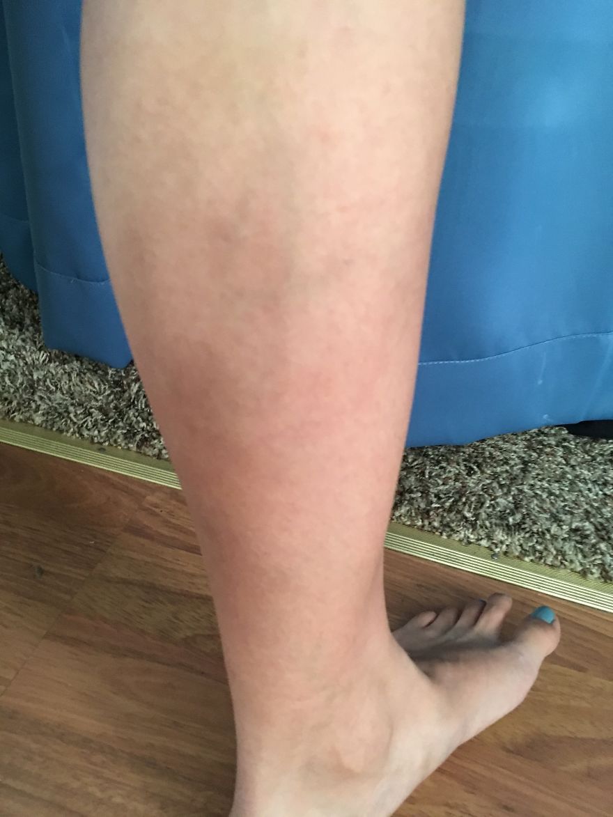 Does Anyone Have A Design Or Number In Their Veins?