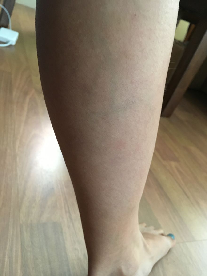 Does Anyone Have A Design Or Number In Their Veins?