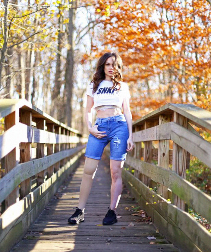 Girl Gets Her Leg Amputated At Age 11 Because Of Cancer, Becomes A Model 20 Years Later