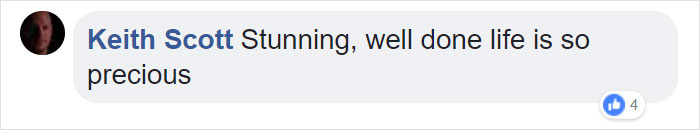 Girl Gets Her Leg Amputated At Age 11 Because Of Cancer, Becomes A Model 20 Years Later Girl Gets Her Leg Amputated At Age 11 Because Of Cancer, Becomes A Model 20 Years Later