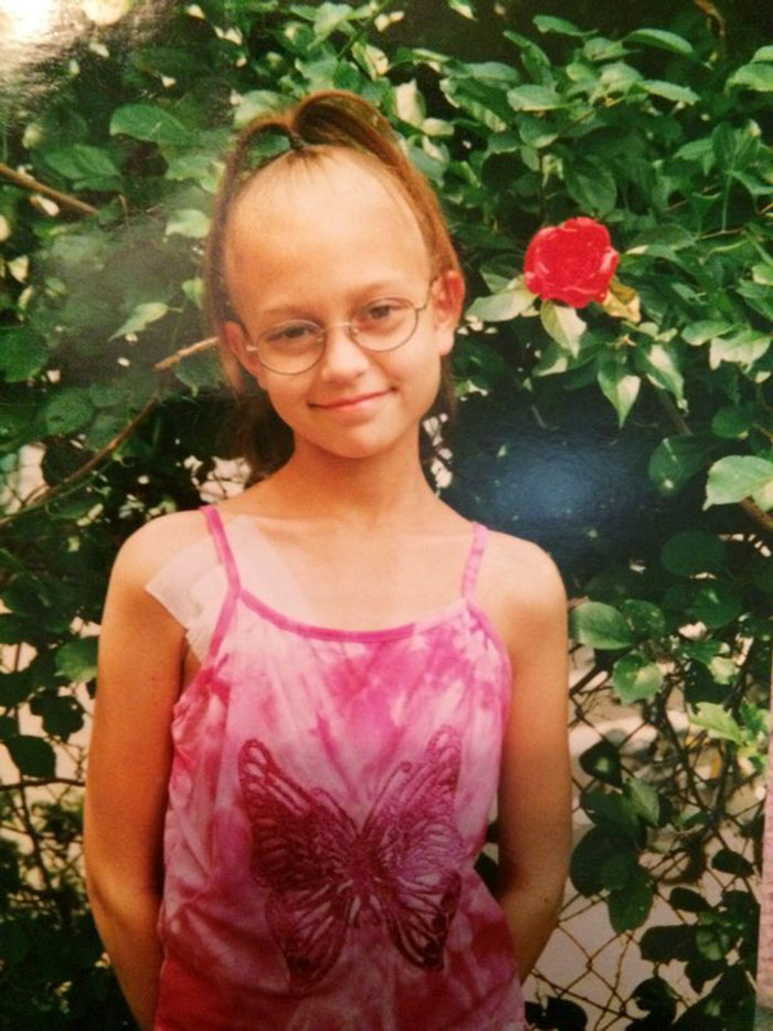 Girl Gets Her Leg Amputated At Age 11 Because Of Cancer, Becomes A Model 20 Years Later