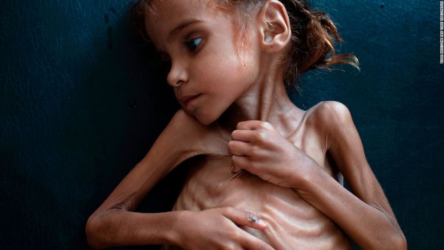 Please Help With The Biggest Humanitarian Crisis Happening In Yemen
