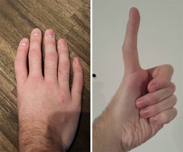 Five Fingers, No Thumb