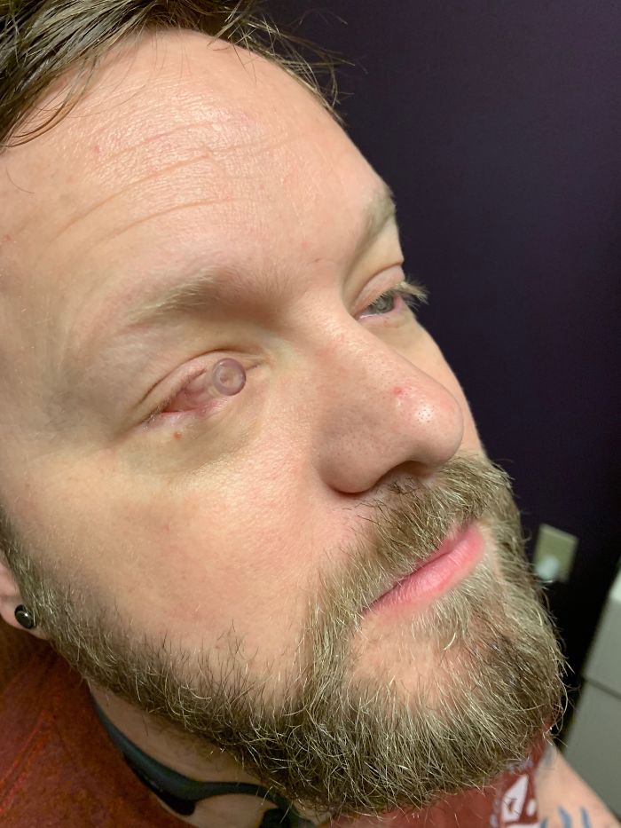 7 Months Ago My Husband Lost His Eye, I Documented The Weekend When He Finally Got A New One (Warning: Sensitive Content)