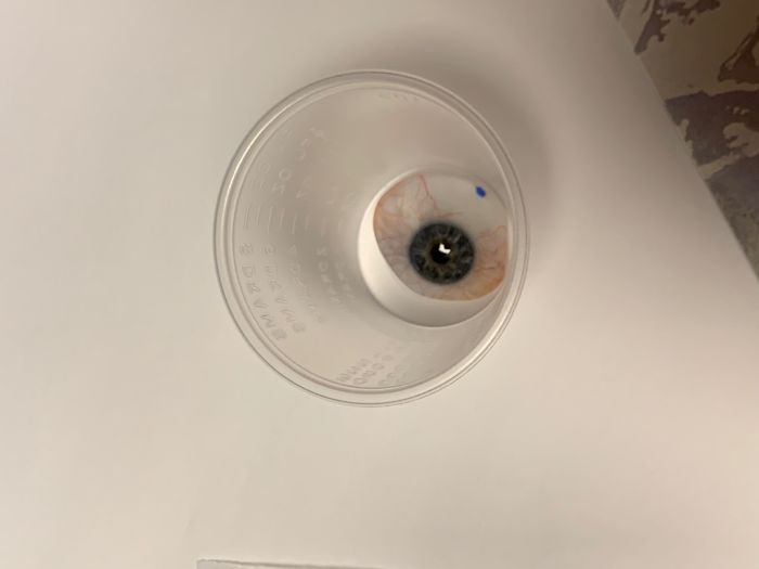 7 Months Ago My Husband Lost His Eye, I Documented The Weekend When He Finally Got A New One (Warning: Sensitive Content)