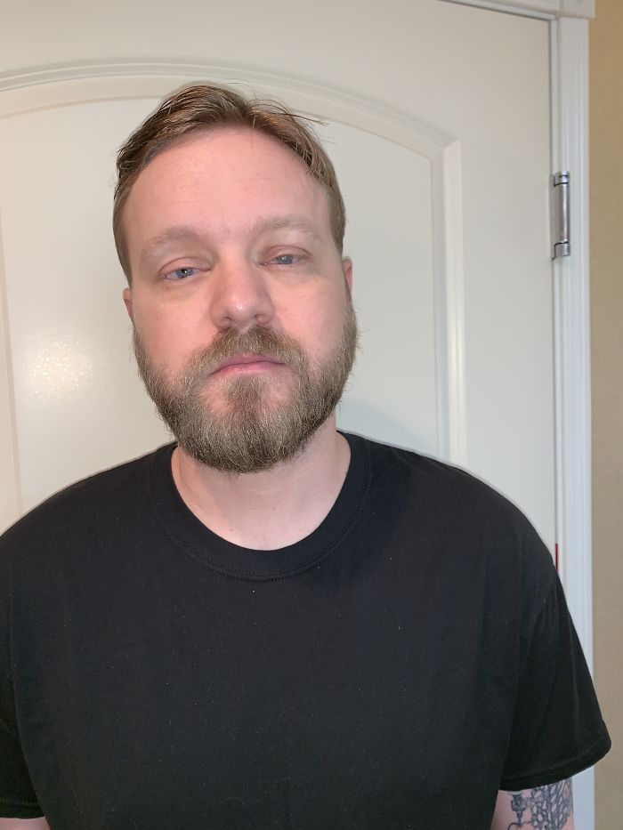 7 Months Ago My Husband Lost His Eye, I Documented The Weekend When He Finally Got A New One (Warning: Sensitive Content)