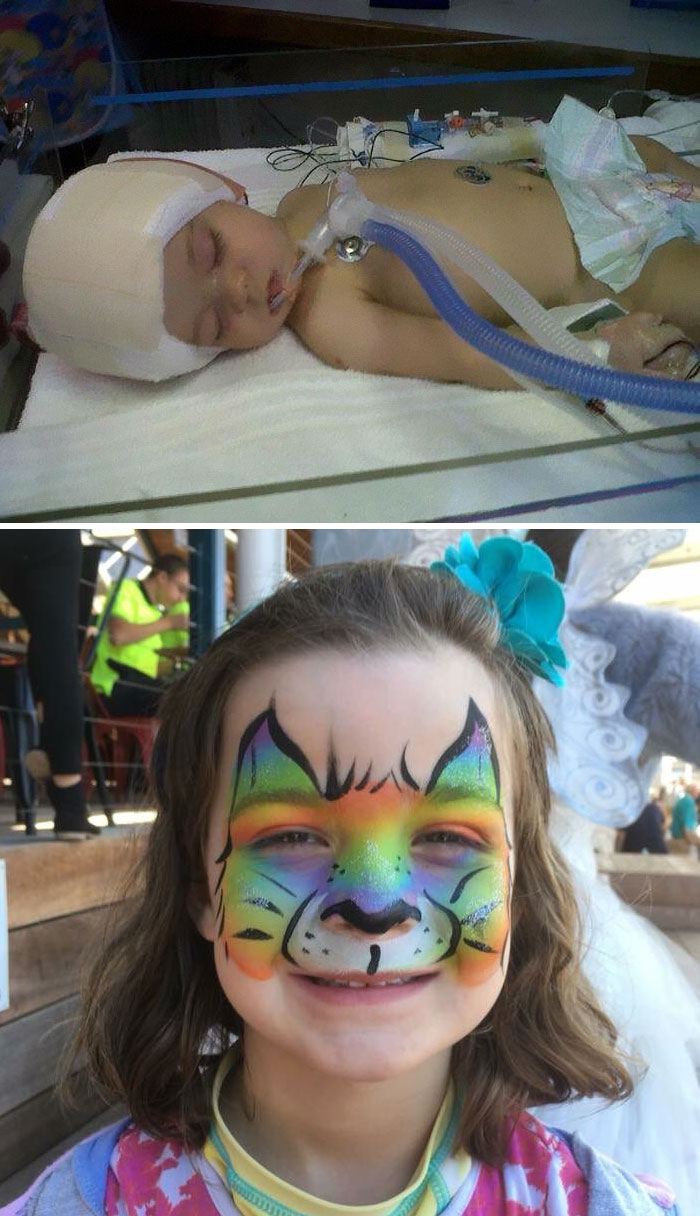 My Daughter Was Born With Craniosynostosis. At 8 Months, Her Skull Was Removed And Reshaped. Today, She Is A Healthy, Happy 7 Year Old! Go Miles!