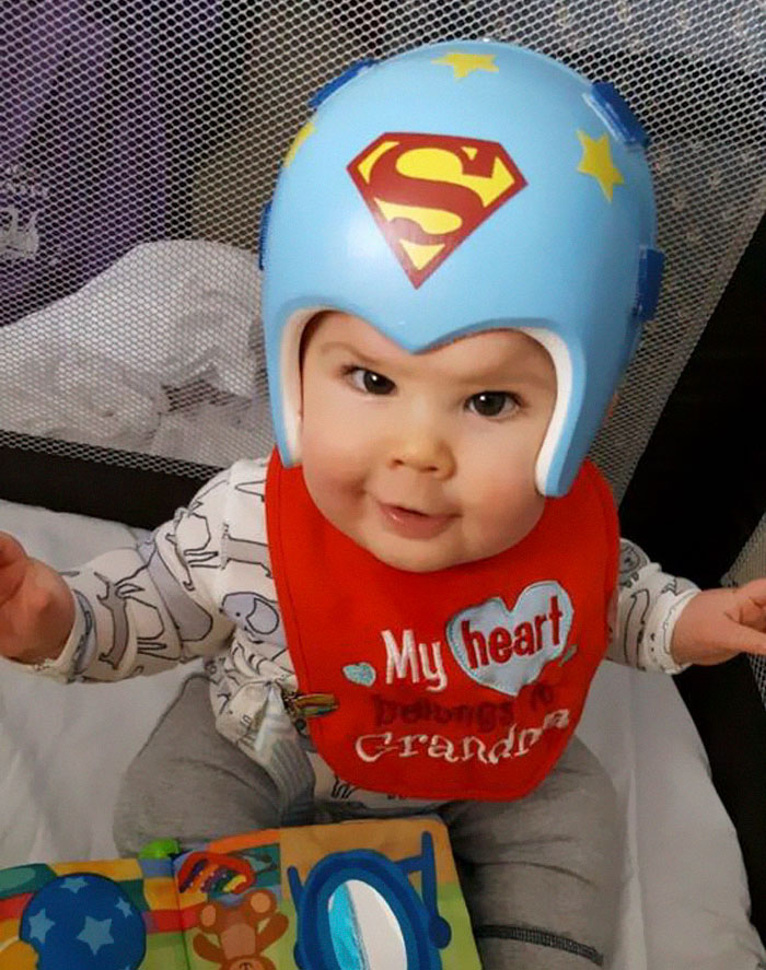 Our Little Guy Is 2 Now And Is Just As Perfect As Ever-Craniosynostosis Superbaby!! ❤️