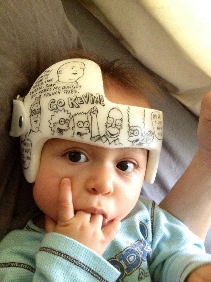 My Son 6 Years Ago! He Has A Perfectly Rounded Head Now. 😊