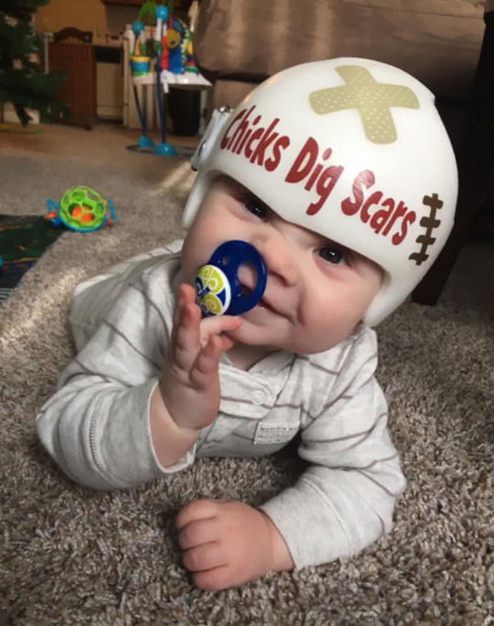 My Cranio Warrior Rocked His For 10 Weeks Post Op Cvr!