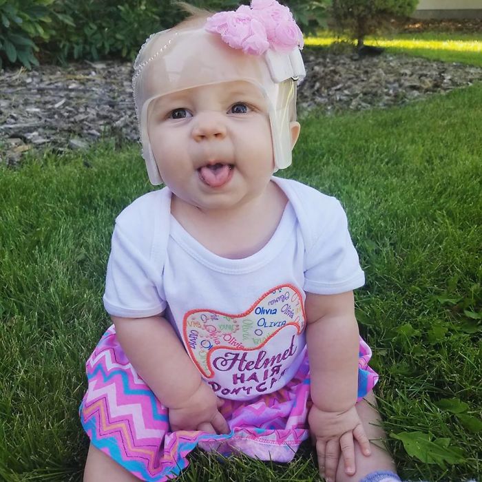 My Sassy Pants Girl Loved Her Helmet! Her Onsie Says "Helmet Hair, Don't Care!" She Was Actually The Fastest Helmet Graduate In Our Whole State, Since We Got It On Right Before A Growth Spurt, And Was Done In 5 Weeks With It.