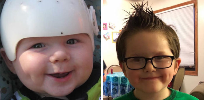 My Middle Baby Had To Wear A Helmet And He’s Now An Adorable 1st Grader. 😊