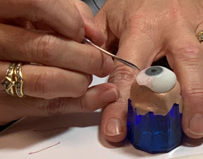 7 Months Ago My Husband Lost His Eye, I Documented The Weekend When He Finally Got A New One (Warning: Sensitive Content)