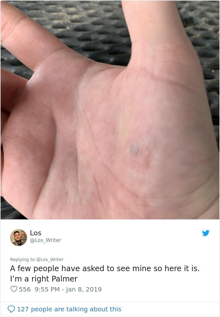 Apparently, Pencil Scars Are A Thing And There Are More People Affected Then You Would Think Apparently, Pencil Scars Are A Thing And There Are More People Affected Then You Would Think